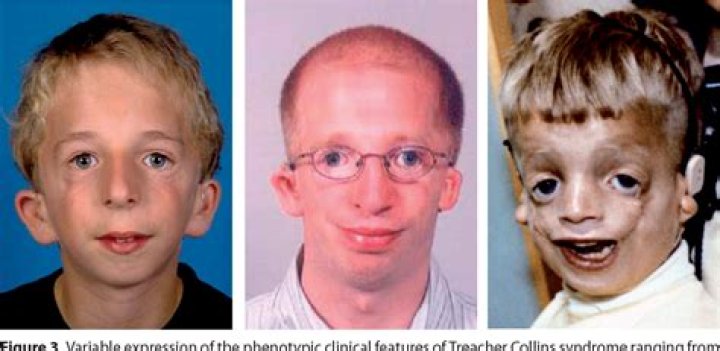 Treacher Collins Syndrome Before And After